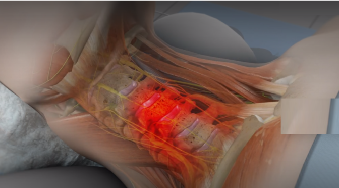 Microdiscectomy vs. Traditional Discectomy: Which Spine Surgery Is Right for You?