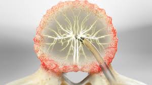 Basivertebral Nerve Ablation for Chronic Back Pain: A Complete Guide