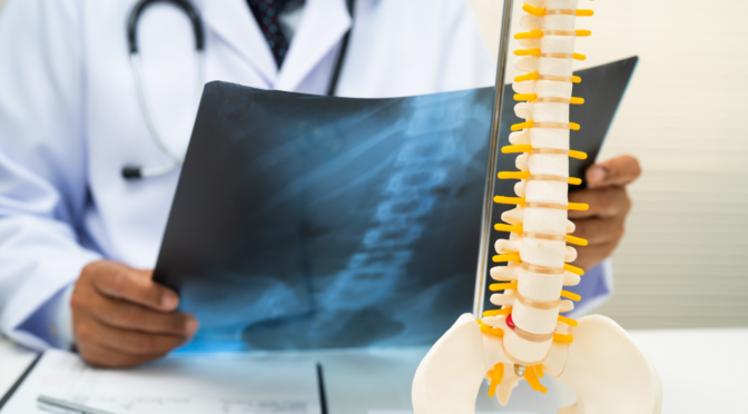 Intrathecal Pain Pumps: Advanced Treatment for Severe Chronic Pain 